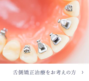 舌側矯正治療をお考えの方