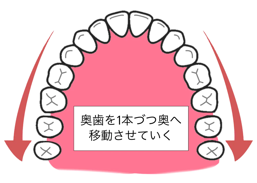 奥歯を奥へ移動させる