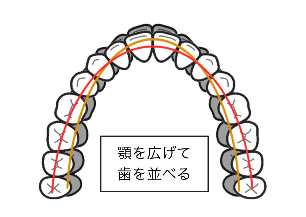 歯列の幅の拡張