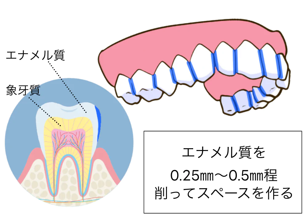 歯を僅かに削って拡張