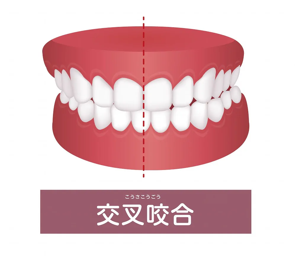 上下の咬み合わせが交叉している（交叉咬合、クロスバイト）